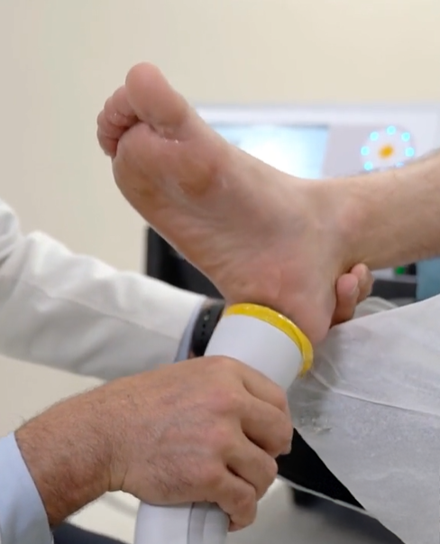 Softwave plantar fasciitis